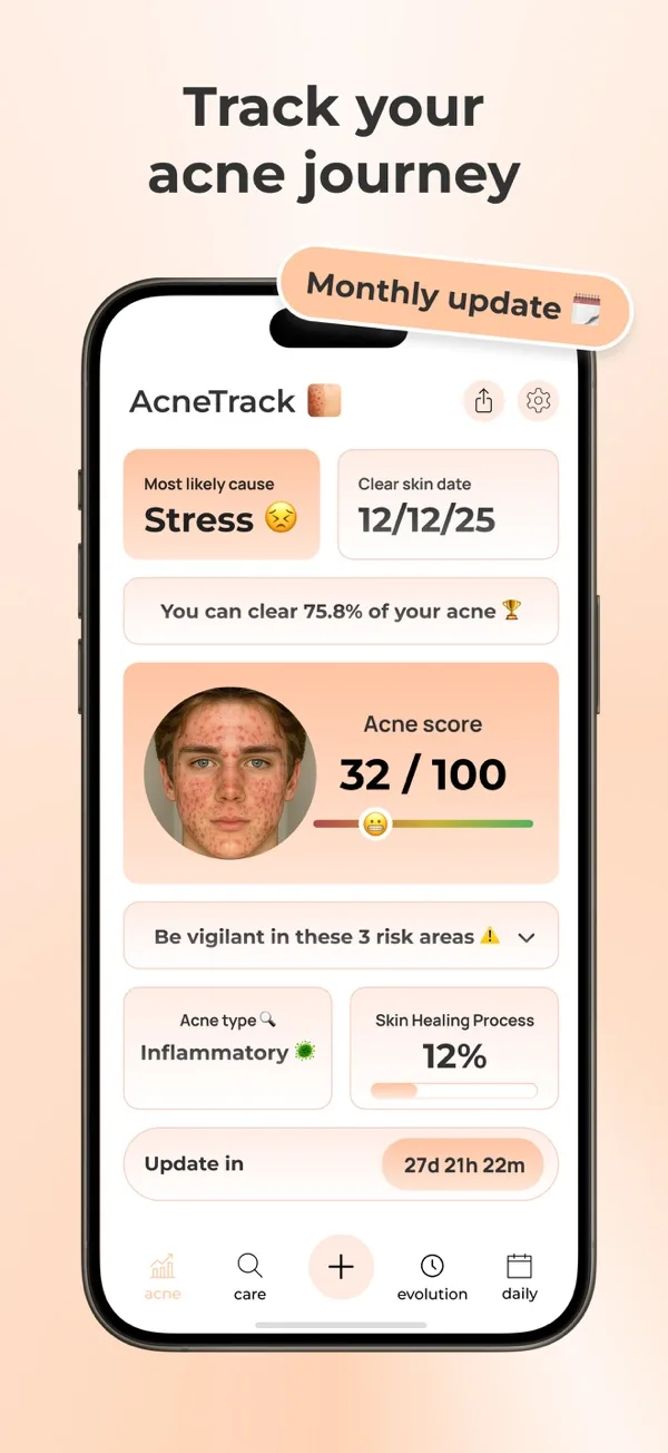 AcneTrack app progress screen with an acne score of 32 out of 100 and a predicted clear skin date.